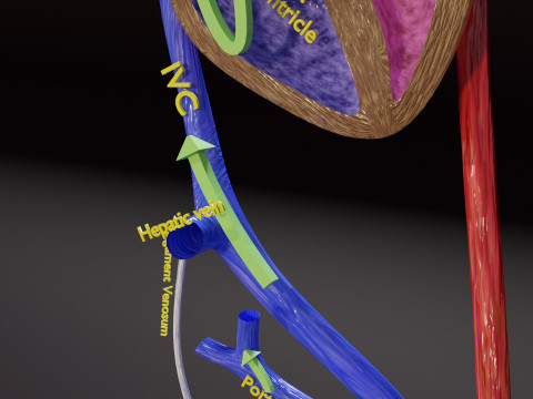 PDA Patent Ductus Arteriosus vs Normal blood circulation 3D Model
