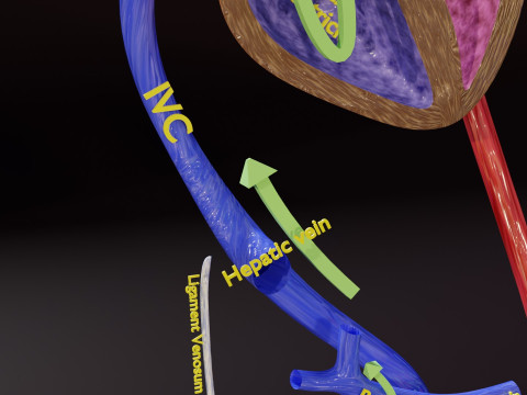 PDA Patent Ductus Arteriosus vs Normal blood circulation 3D Model
