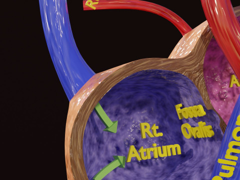 PDA Patent Ductus Arteriosus vs Normal blood circulation 3D Model