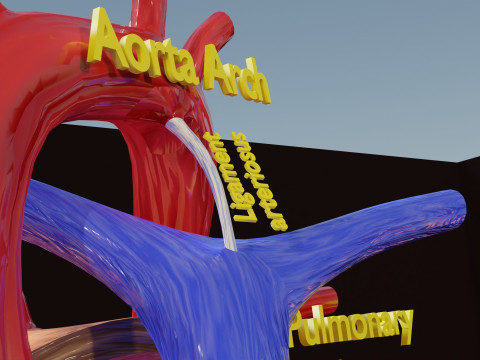 PDA Patent Ductus Arteriosus vs Normal blood circulation 3D Model
