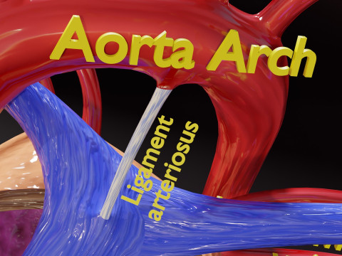 PDA Patent Ductus Arteriosus vs Normal blood circulation 3D Model