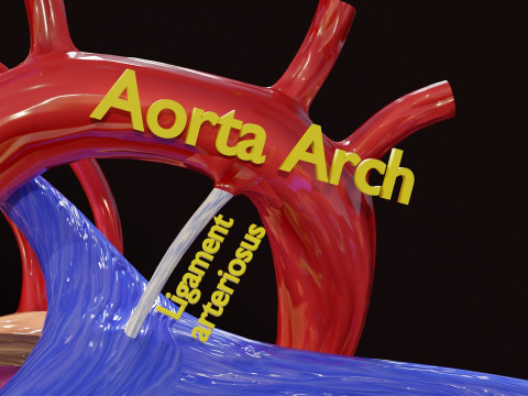 PDA Patent Ductus Arteriosus vs Normal blood circulation 3D Model