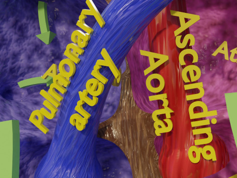 PDA Patent Ductus Arteriosus vs Normal blood circulation 3D Model