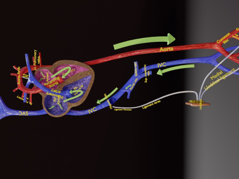 PDA Patent Ductus Arteriosus vs Normal blood circulation 3D Model