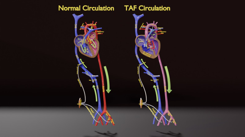 TAF Tetralogy of Fallot vs Normal circulation 3D मॉडल .c4d .max .obj .3ds .fbx .stl .blend 