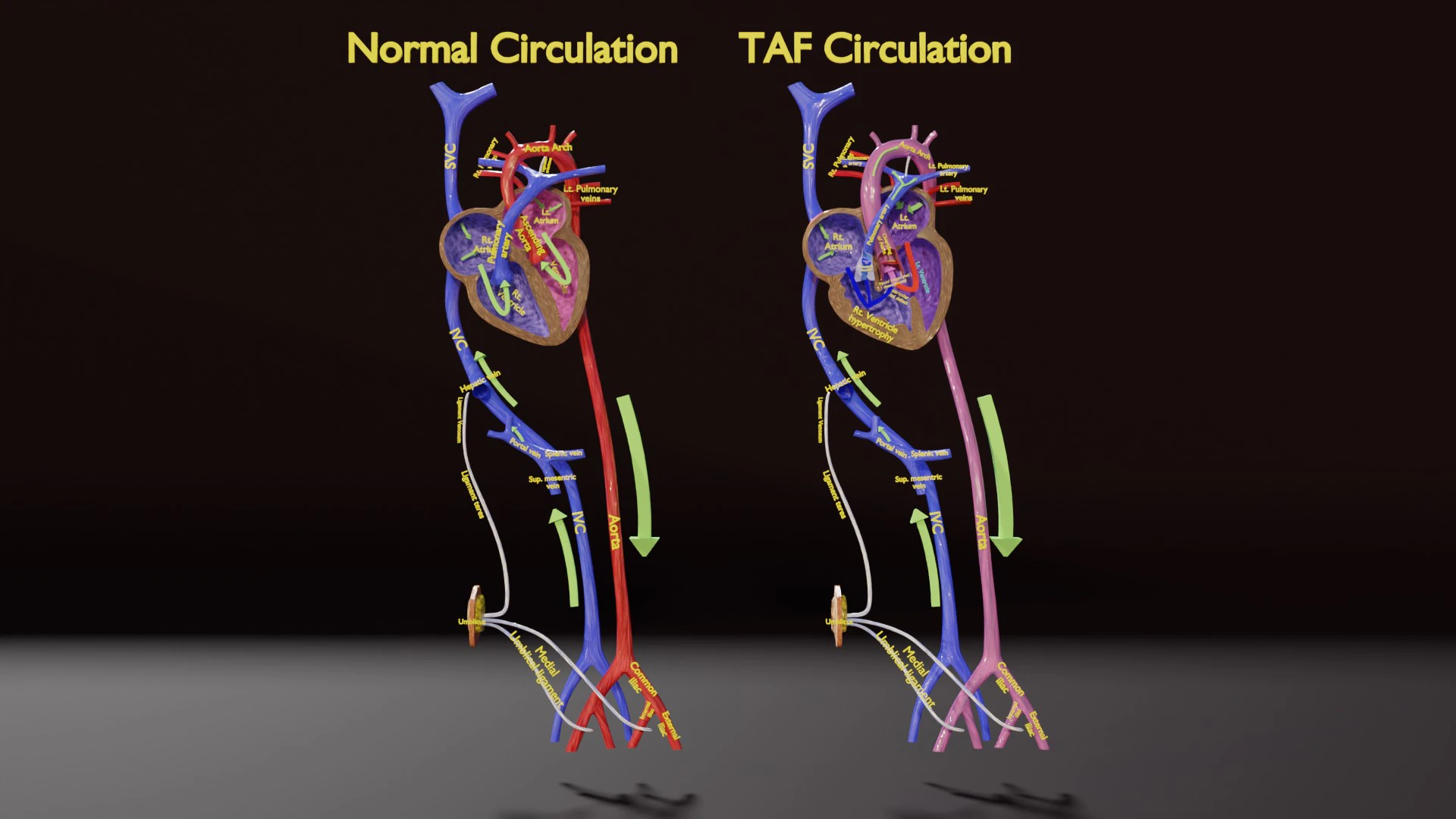 TAF Tetralogy of Fallot vs Normal circulation 3D Model .c4d .max .obj .3ds .fbx .stl .blend 
