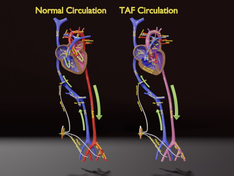 TAF Tetralogy of Fallot vs Normal circulation 3D Model