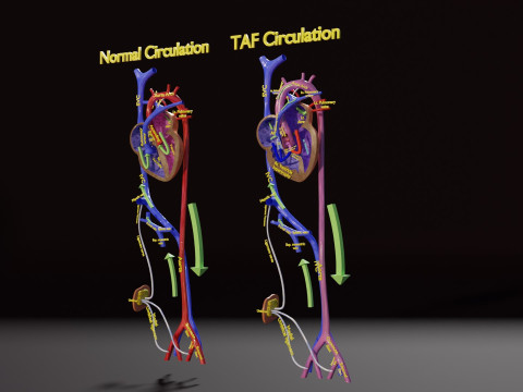 TAF Tetralogy of Fallot vs Normal circulation 3D मॉडल