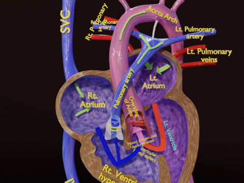 TAF Tetralogy of Fallot vs Normal circulation 3D मॉडल