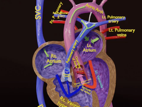 TAF Tetralogy of Fallot vs Normal circulation 3D Model
