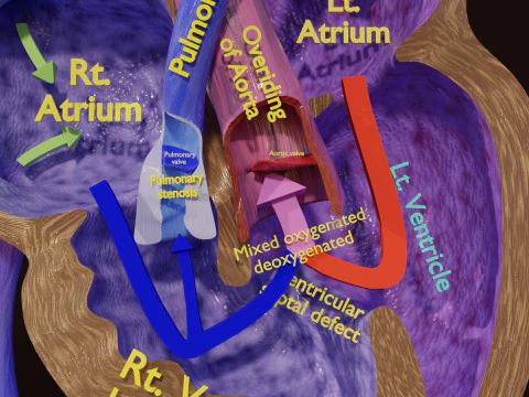 TAF Tetralogy of Fallot vs Normal circulation 3D Model