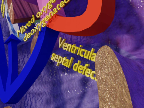 TAF Tetralogy of Fallot vs Normal circulation 3D Model