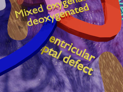 TAF Tetralogy of Fallot vs Normal circulation 3D Model
