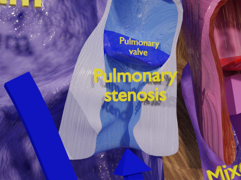 TAF Tetralogy of Fallot vs Normal circulation 3D मॉडल