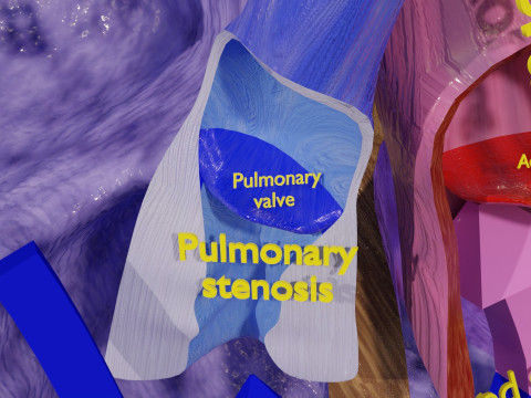 TAF Tetralogy of Fallot vs Normal circulation 3D मॉडल
