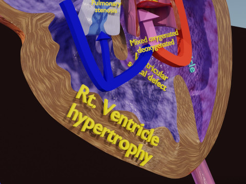 TAF Tetralogy of Fallot vs Normal circulation 3D मॉडल