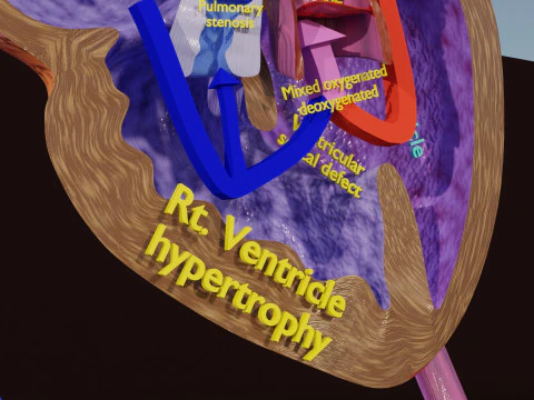 TAF Tetralogy of Fallot vs Normal circulation 3D Model