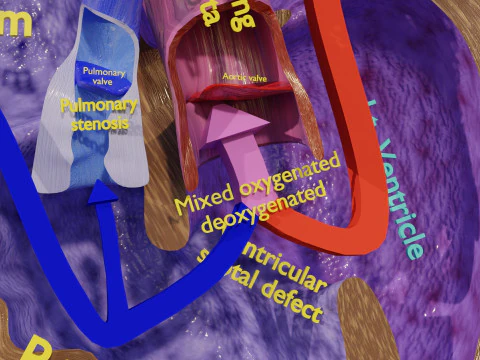 TAF Tetralogy of Fallot vs Normal circulation 3D Model