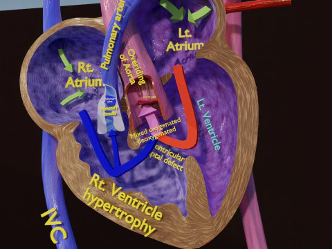 TAF Tetralogy of Fallot vs Normal circulation 3D Model