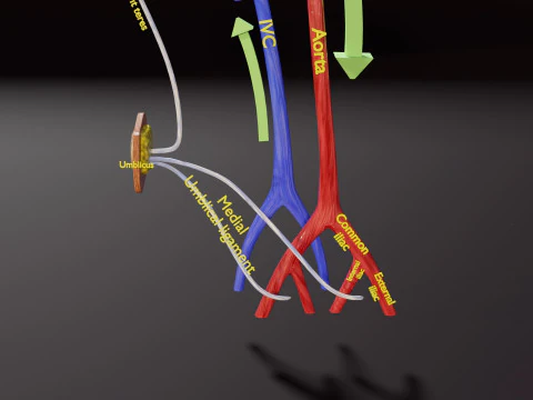 TAF Tetralogy of Fallot vs Normal circulation 3D Model