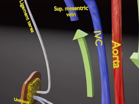 TAF Tetralogy of Fallot vs Normal circulation 3D Model
