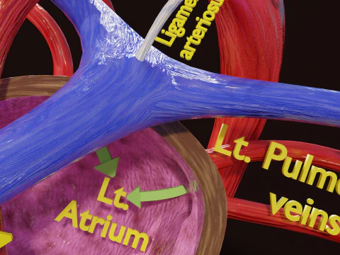 TAF Tetralogy of Fallot vs Normal circulation 3D Model