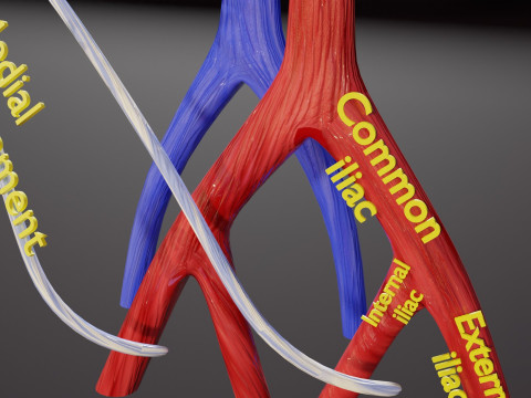 TAF Tetralogy of Fallot vs Normal circulation 3D मॉडल
