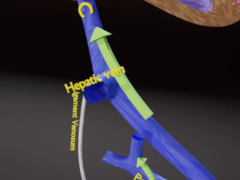 TAF Tetralogy of Fallot vs Normal circulation 3D Model