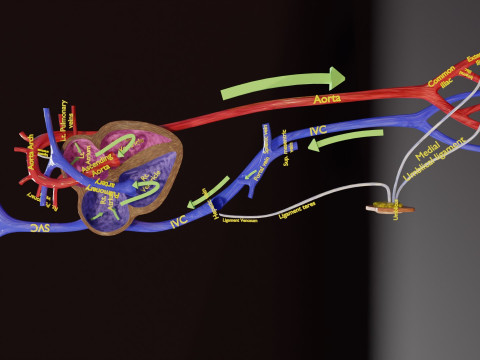 TAF Tetralogy of Fallot vs Normal circulation 3D मॉडल