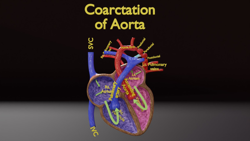 COA Coarctation of Aorta 3D Model .c4d .max .obj .3ds .fbx .stl .blend 