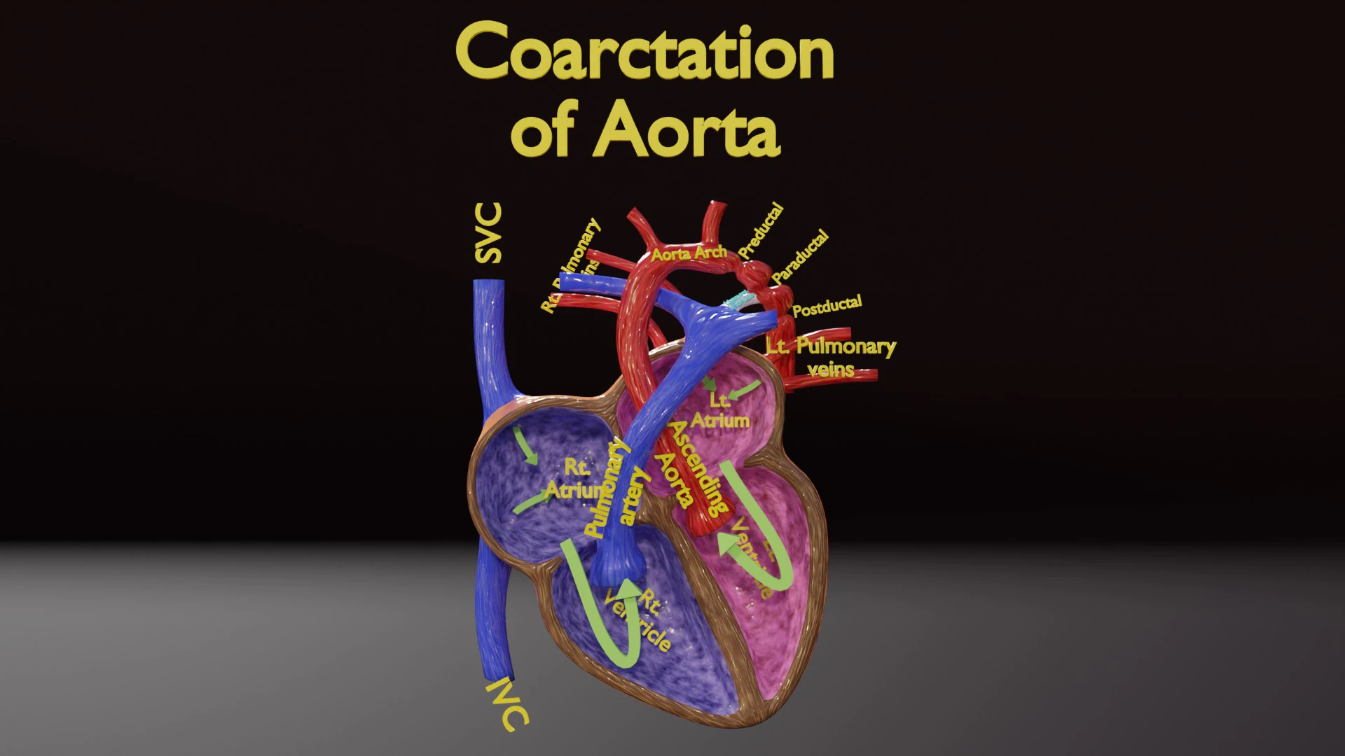 COA Coartaci&oacute;n de Aorta Modelo 3D .c4d .max .obj .3ds .fbx .stl .blend 