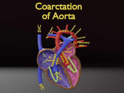 COA Coarctation of Aorta 3D Model
