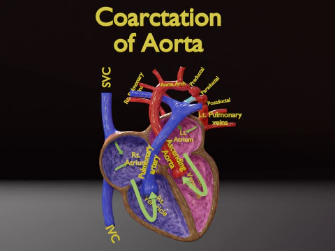 COA Coarcta&ccedil;&atilde;o da Aorta Modelo 3D