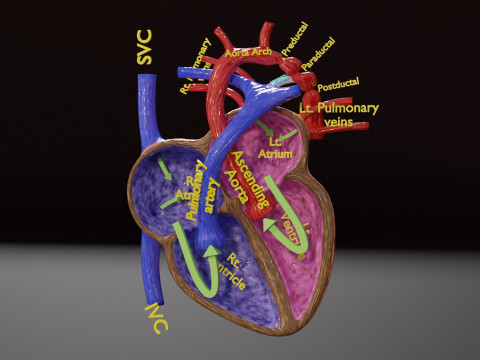 COA Coarctation of Aorta 3D Model