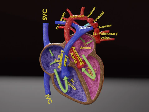 COA Coartaci&oacute;n de Aorta Modelo 3D