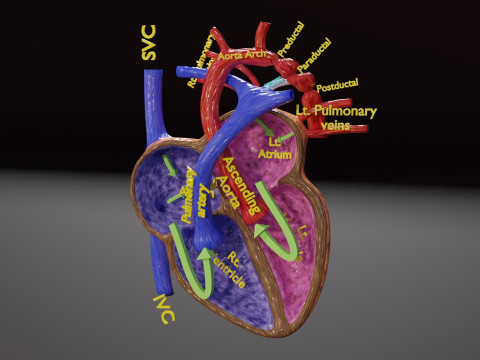 COA Coarctation of Aorta 3D Model