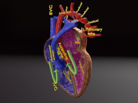 COA Coarctation of Aorta 3D Model