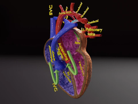 COA Coartaci&oacute;n de Aorta Modelo 3D