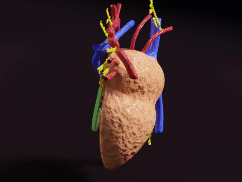 COA Coartaci&oacute;n de Aorta Modelo 3D