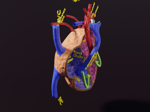 COA Coarctation of Aorta 3D Model
