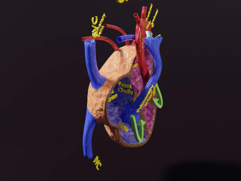 COA Coartaci&oacute;n de Aorta Modelo 3D