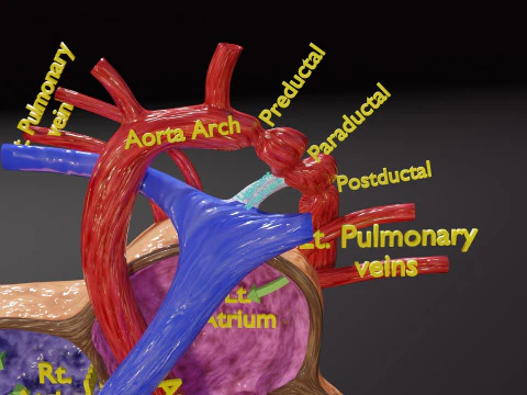 COA Coartaci&oacute;n de Aorta Modelo 3D