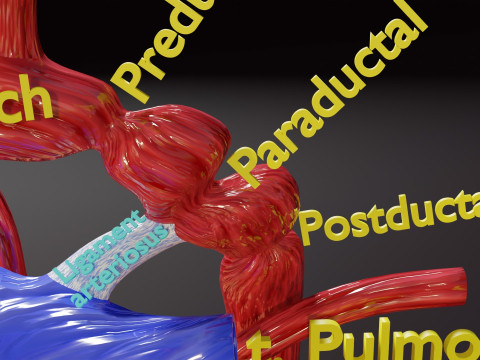 COA Coarctation of Aorta 3D Model