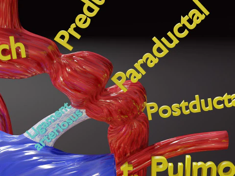 COA Coartaci&oacute;n de Aorta Modelo 3D