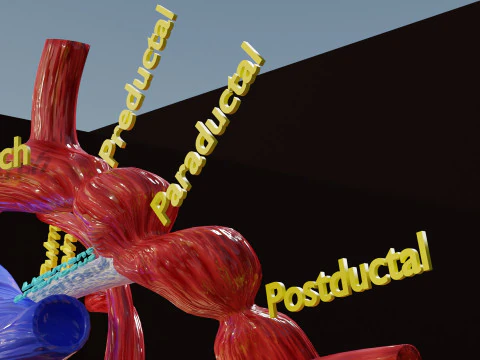 COA Coartaci&oacute;n de Aorta Modelo 3D