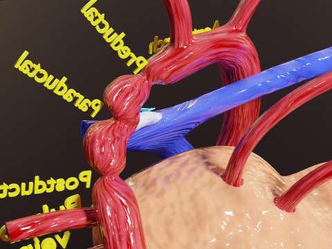 COA Coarctation of Aorta 3D Model