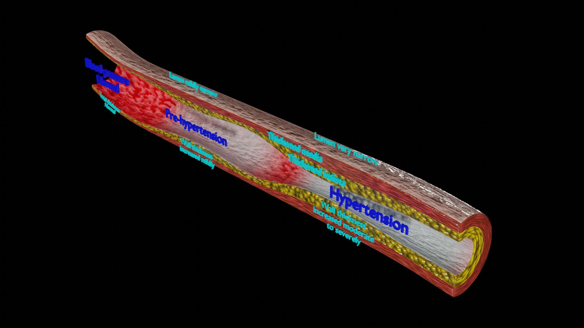 Hypertension blood vessel artery structural change 3D Model .c4d .max .obj .3ds .fbx .stl .blend