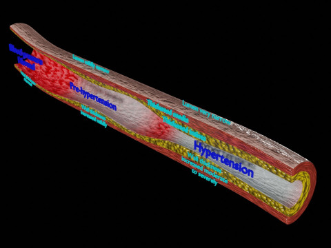 Hypertension blood vessel artery structural change 3D Model