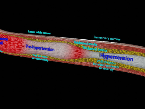 Hypertension blood vessel artery structural change 3D-Modell