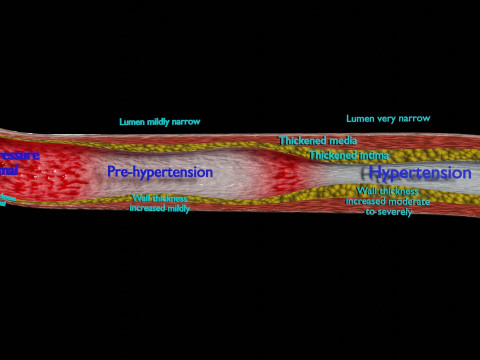 Hypertension blood vessel artery structural change 3D-Modell